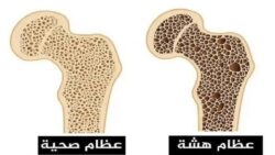 أسباب هشاشة العظام وأعراضها
