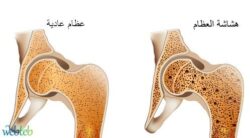 أسباب هشاشة العظام وأعراضها