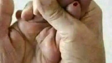 بروفيسور صينى وطريقة إنقاذ الجلطة الدماغية