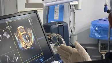 جامعة سوهاج تجري اول حالة لاصلاح الصمام الميترالي بالقسطرة بتقنية«Mitral Clip»
