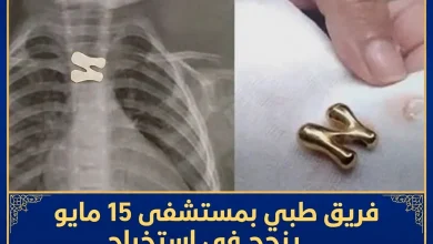 فريق طبي بمستشفى 15 مايو ينجح في استخراج دلاية سلسلة ابتلاعها طفل