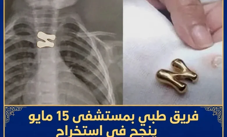 فريق طبي بمستشفى 15 مايو ينجح في استخراج دلاية سلسلة ابتلاعها طفل