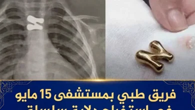 فريق طبي بمستشفى 15 مايو ينجح في استخراج دلاية سلسلة ابتلاعها طفل